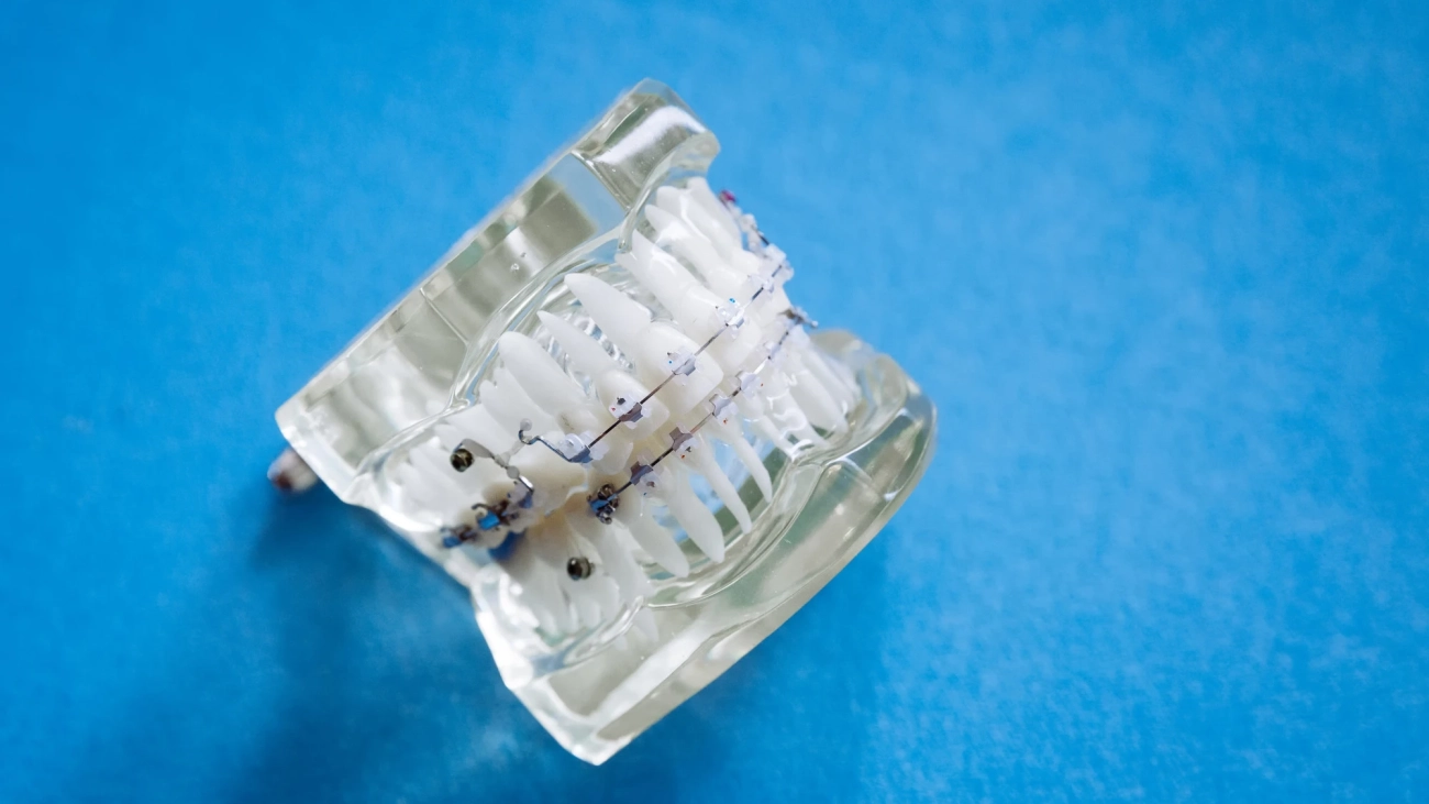 تفاوت ارتودنسی متحرک و ثابت - مقایسه ارتودنسی متحرک و ثابت