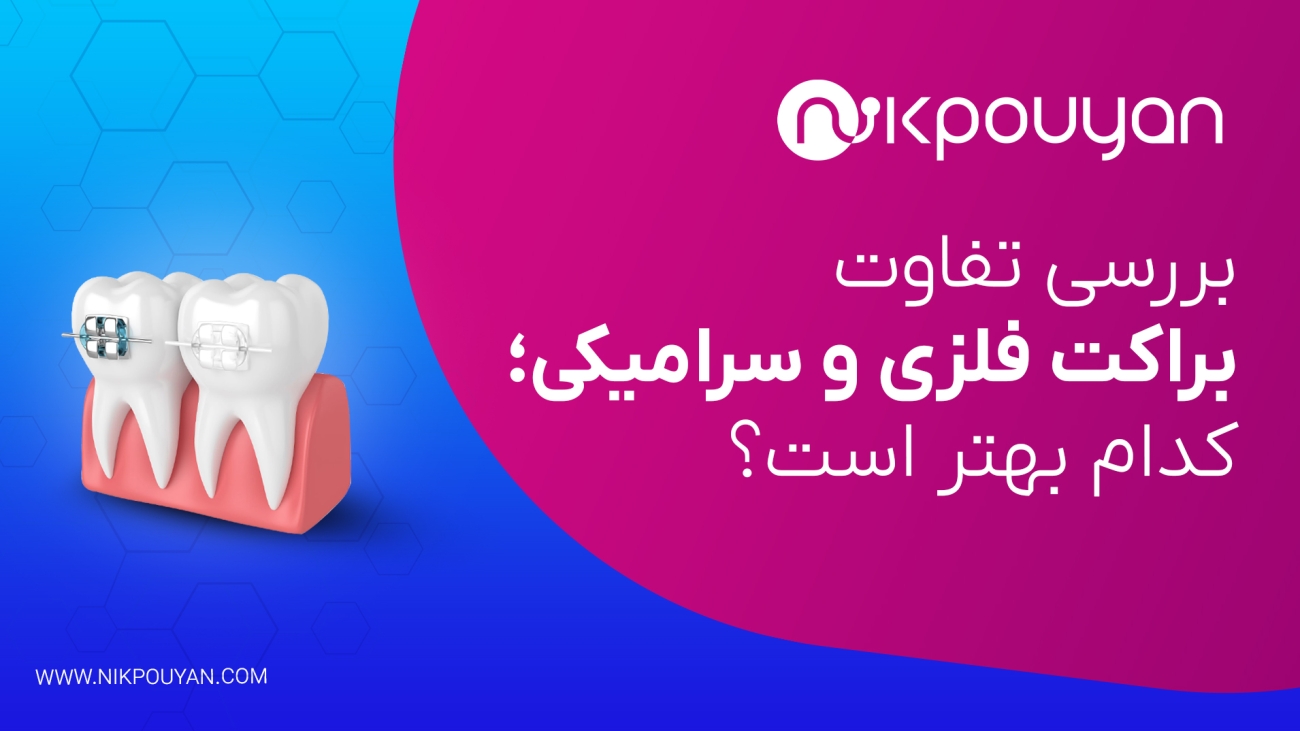 TAFAVOT BROCKET METAL-CERMIC