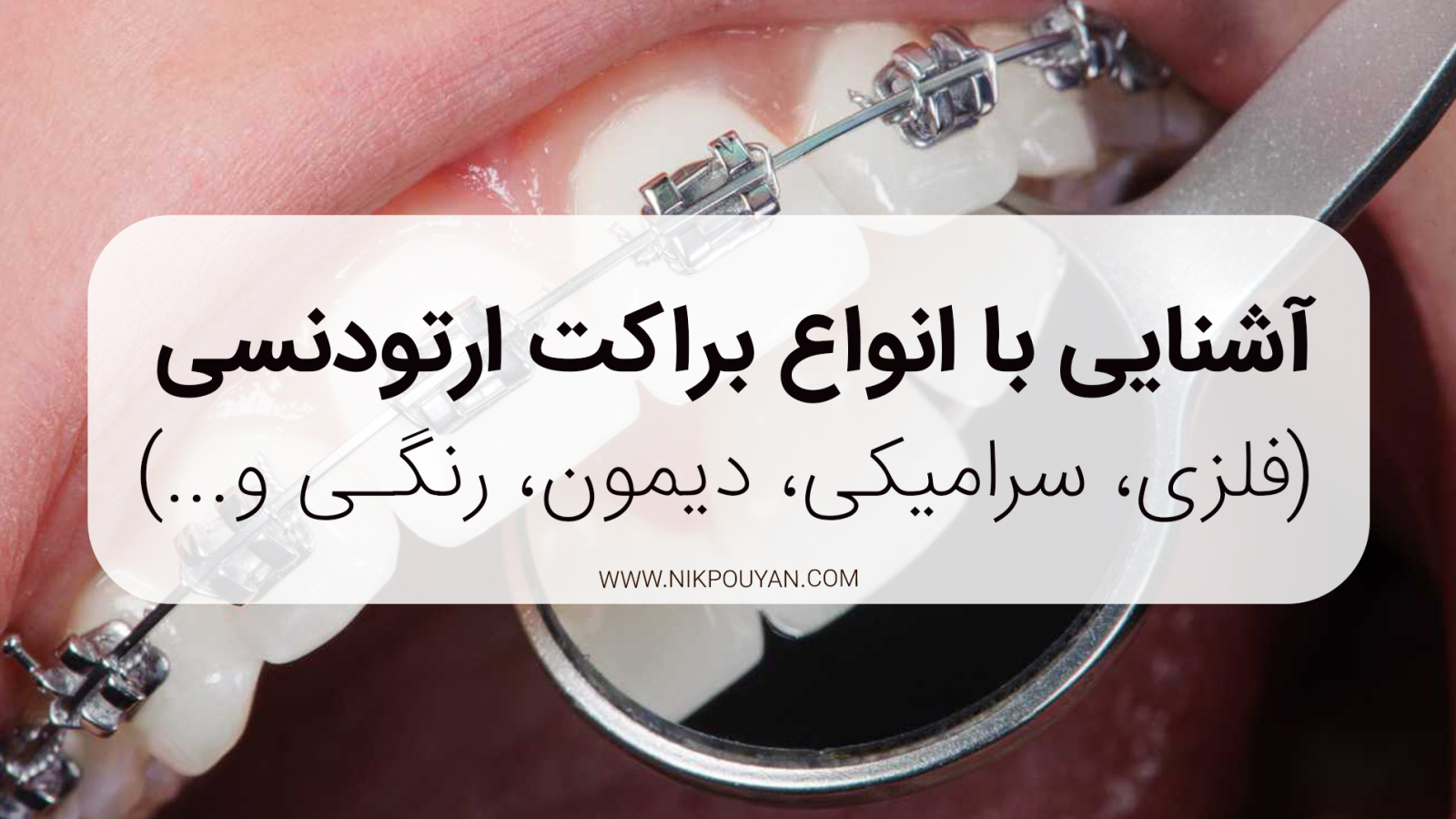 انواع براکت ارتودنسی