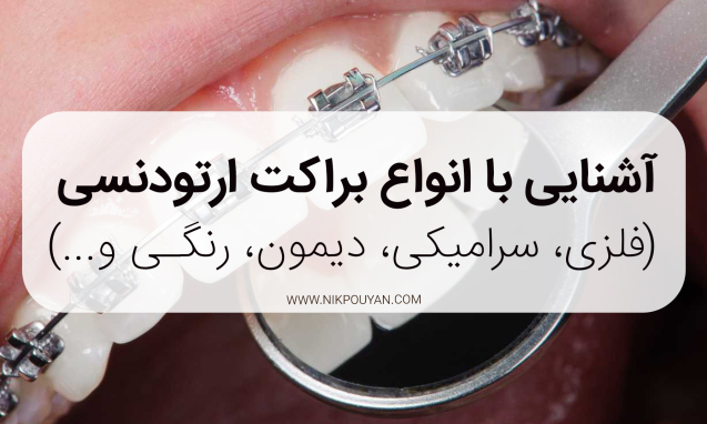 انواع براکت ار‌تودنسی