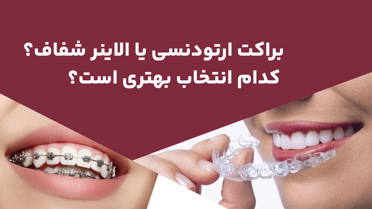 1772623374_ORTHO-ALIGNER