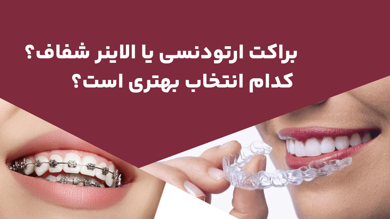 1772623374_ORTHO-ALIGNER