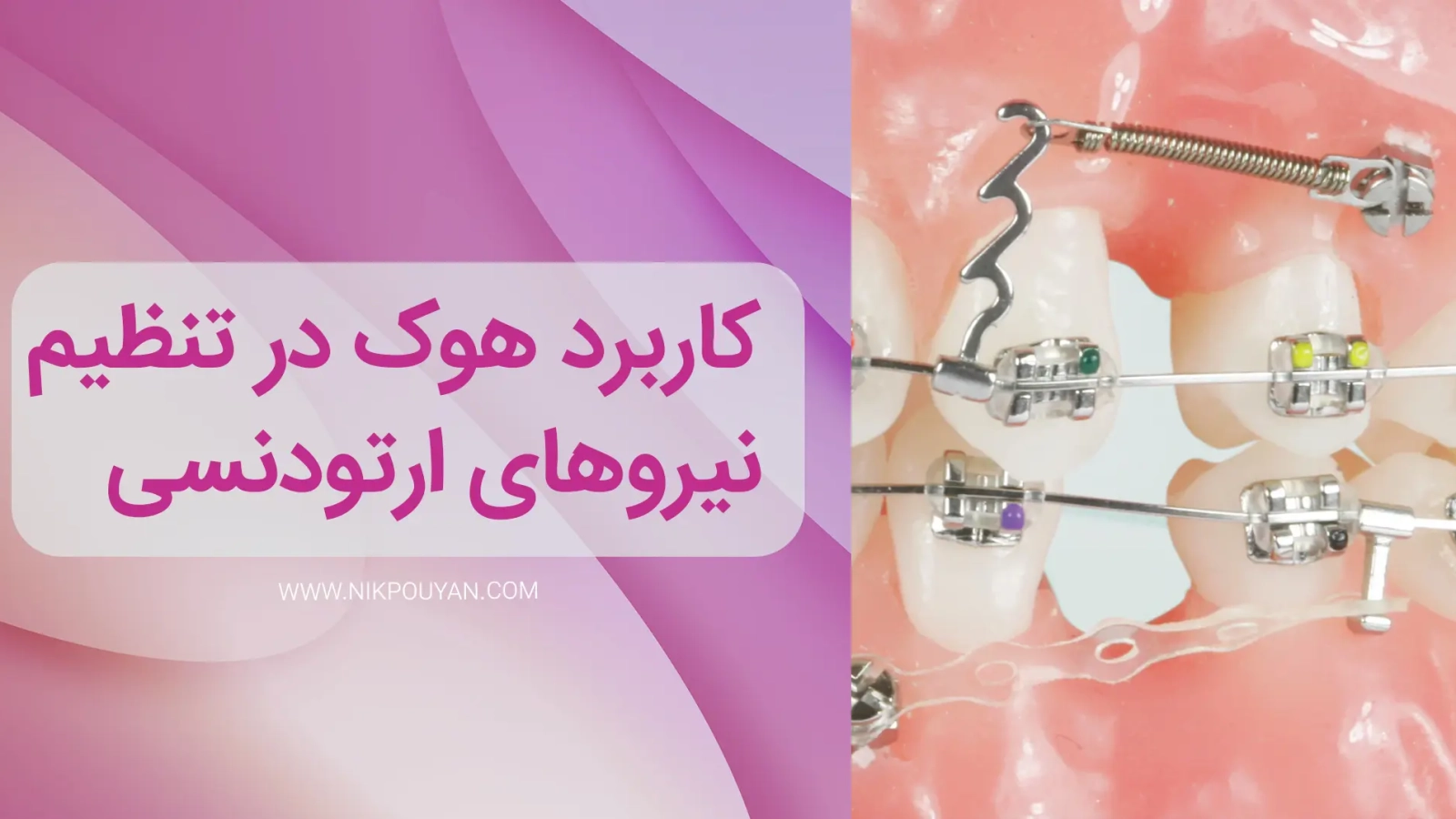 کاربرد هوک در ارتودنسی