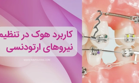 کاربرد هوک در ارتودنسی