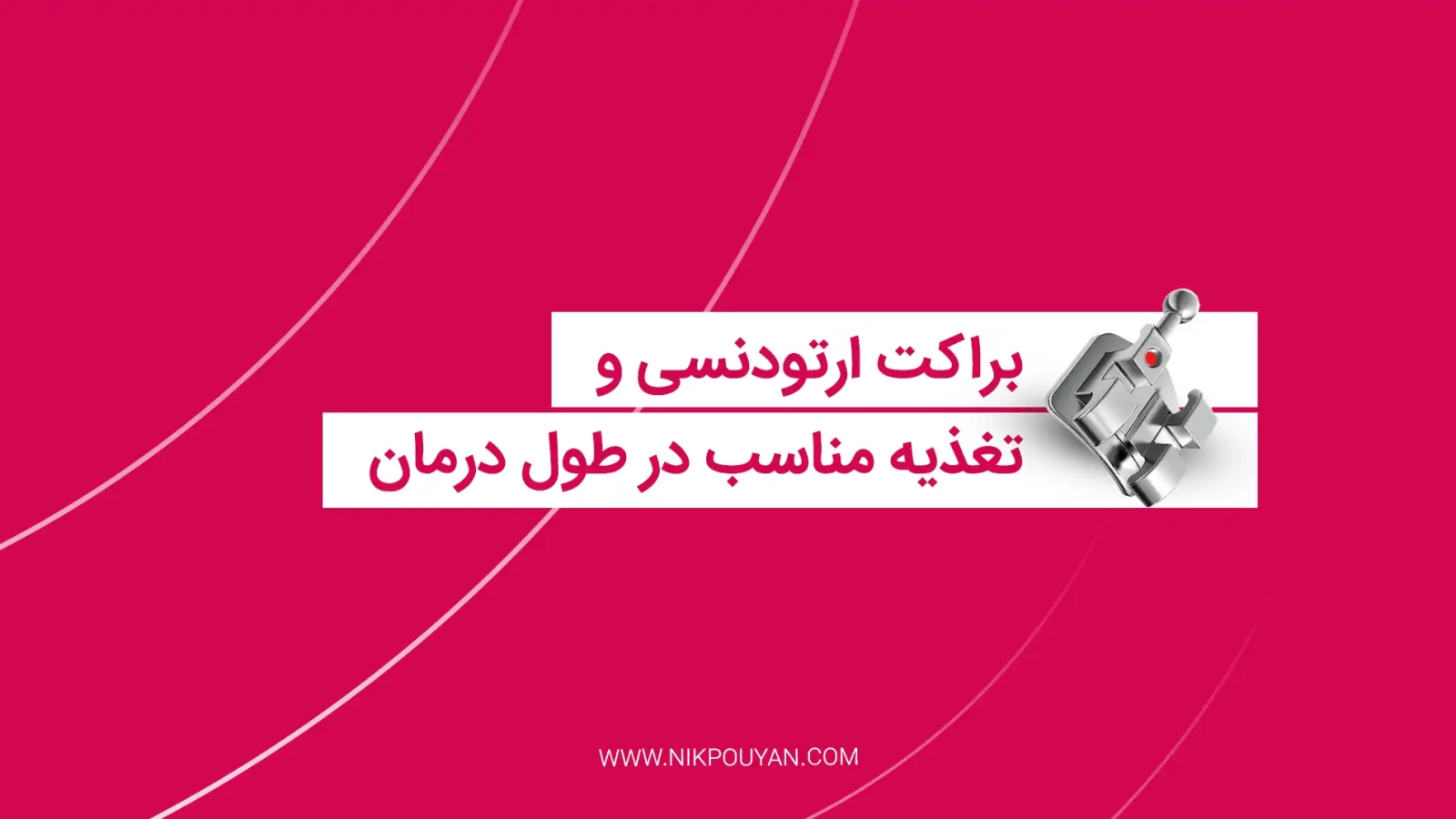 تغذیه مناسب با براکت ارتودنسی