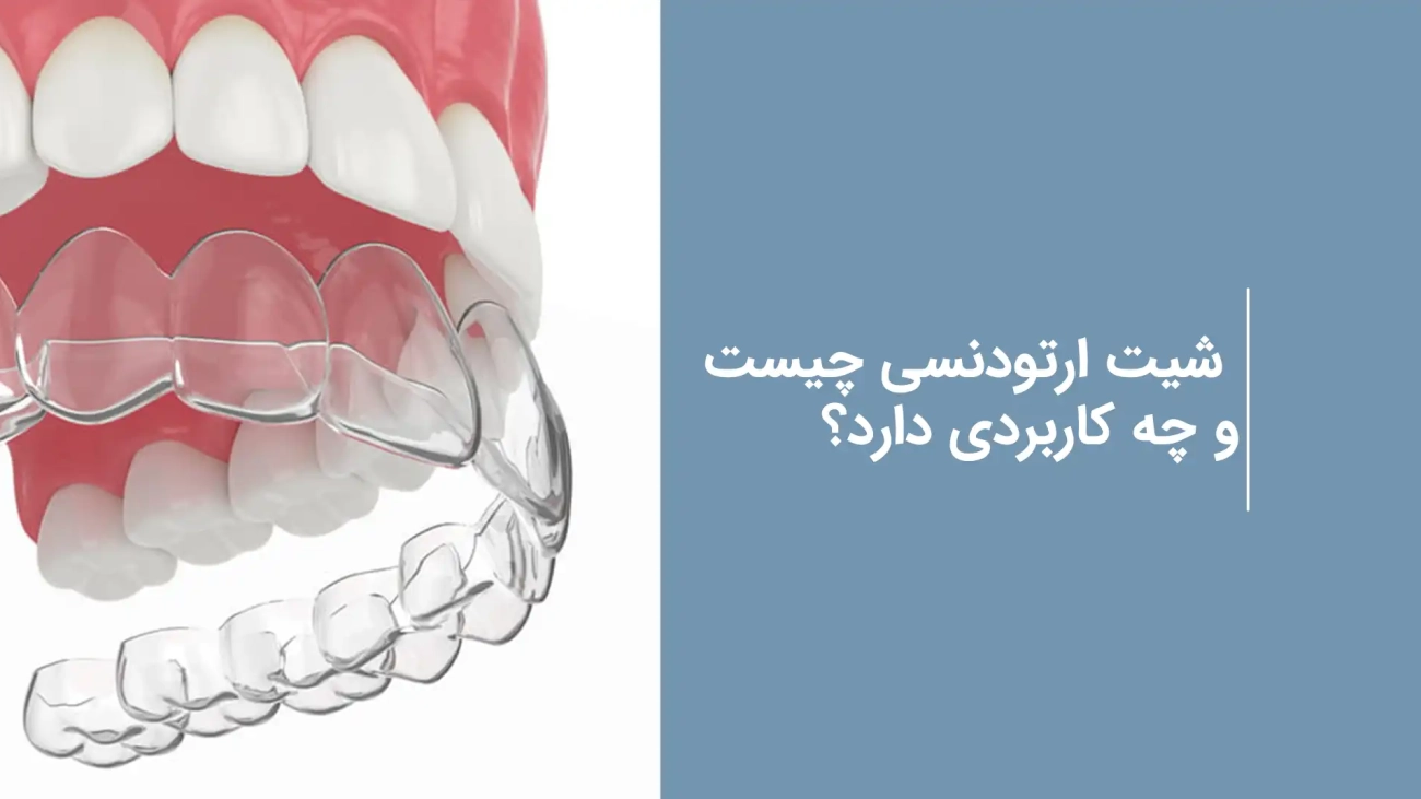 شیت ارتودنسی چیست
